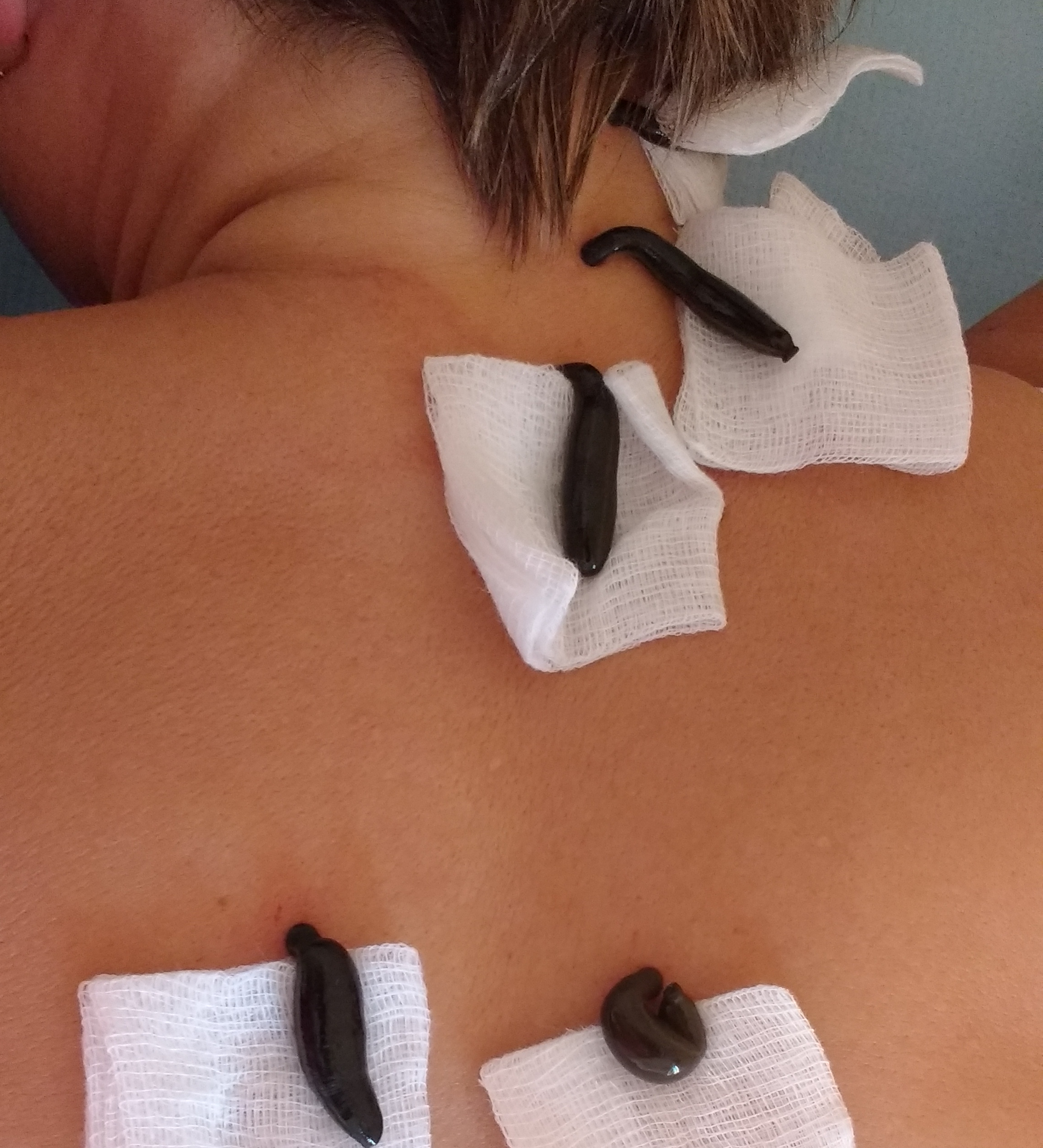 Terapia pijawką lekarską w praktyce fizjoterapeuty